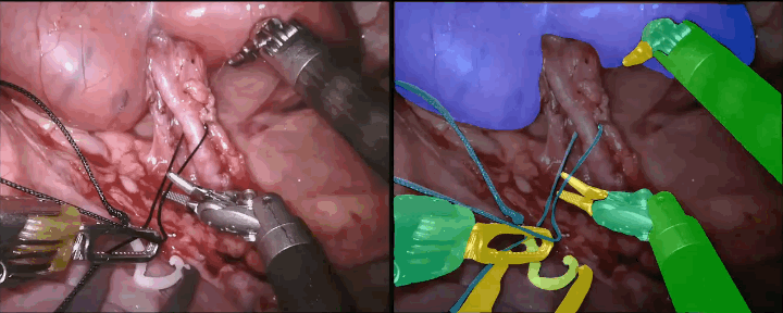 Q-VISION: Real-Time Surgical AI for Kidney Cancer Surgery